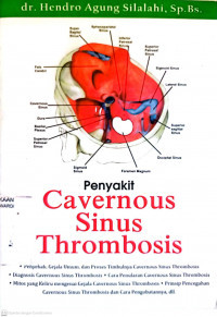 Image of Penyakit Cavernous Sinus Thrombosis